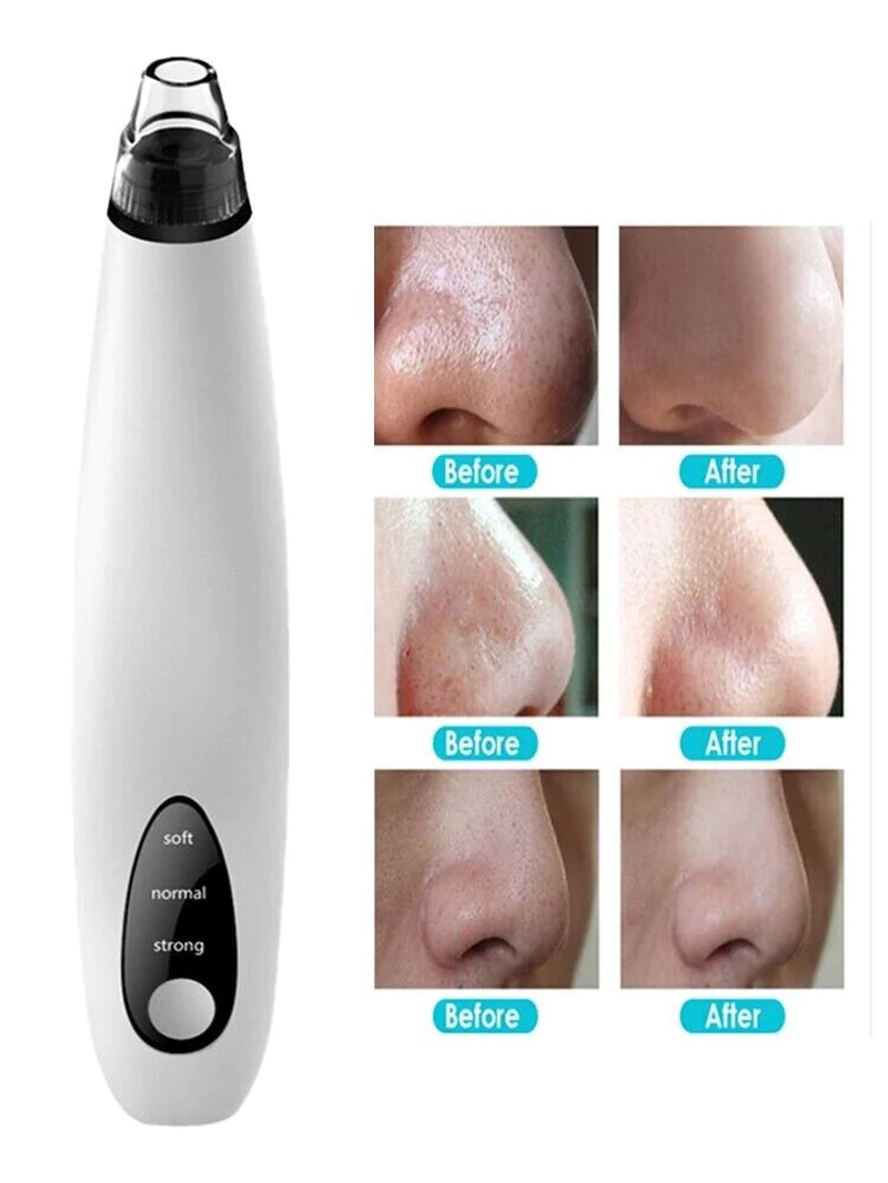 Electric Blackhead Remover Kit –Pore Vacuum Cleaner Kit with Adjustable Suction, Rechargeable Device & Interchangeable Heads for Face Skincare